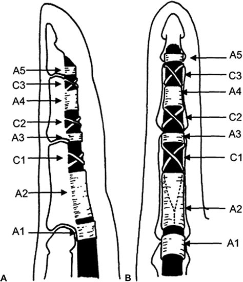 Flexor Pulley System Anatomy Injury And Management Journal Of Hand