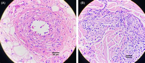 Scielo Brasil Leukocytoclastic Vasculitis In A Patient With