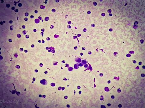 Synovial Fluid Cytology, Plenty WBC, microscopic examination of ...