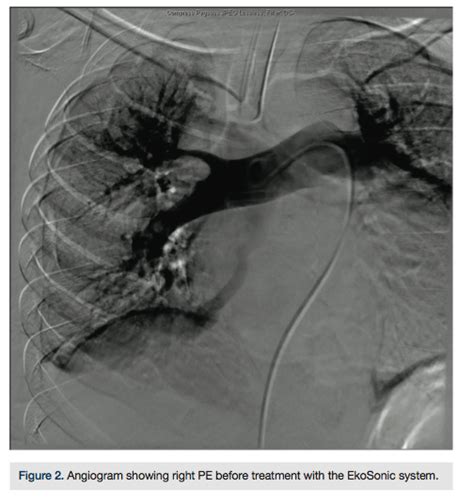 Saddle Embolus And Right Atrial Clot Using Catheter Directed Thrombolysis For Management Of