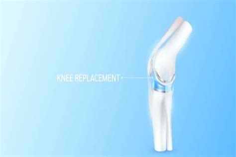 Robotic Knee Replacement Surgery Revolutionizing Orthopedic Care