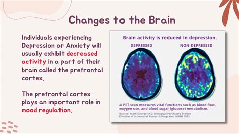 Tms Clinic Perth Transcranial Magnetic Stimulation Neuralia Tms