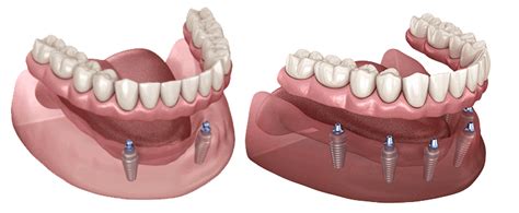 Denture Implants Calgary Denture Clinic Dentures And Implants