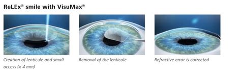 Smile Lasik Surgery Why Youngsters Are Opting For Bladeless Spectacle