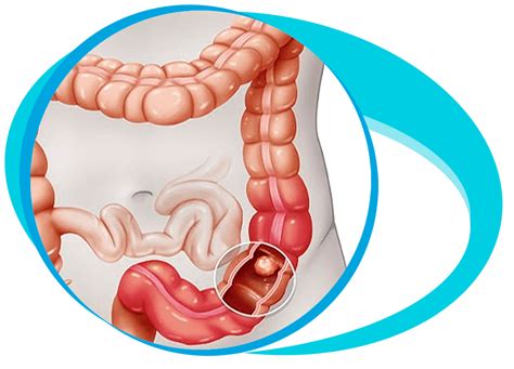 Colon Cancer Treatment In Iran Medpersia Medical Tourism