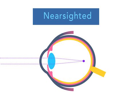 Refractive Errors What Are They And How Are They Corrected