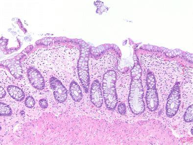 Normal Rectal Mucosa With Minimal Crypt Architectural Distortion The