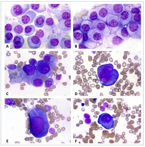 Plasma Cell Myeloma Haematologica Artofit