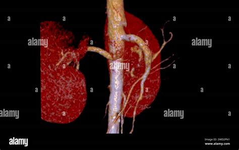 Cta Renal Artery 3d Is A Medical Imaging Procedure Using Ct Scans To Examine The Renal Arteries