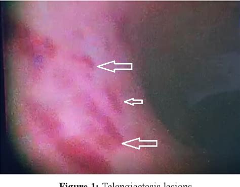 Figure 1 From Hereditary Hemorrhagic Telangiectasia A Case Report With