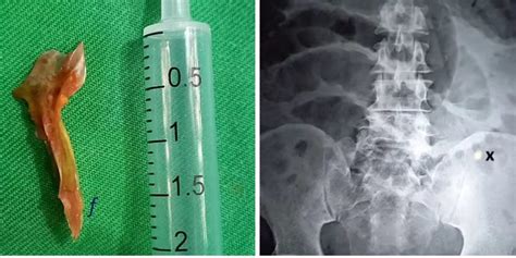 Man Dies After Swallowing Huge, Hooked Fish Bone That Pierced His Guts ...