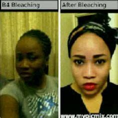 18 New Skin Bleaching ideas | skin bleaching, skin, lighten skin