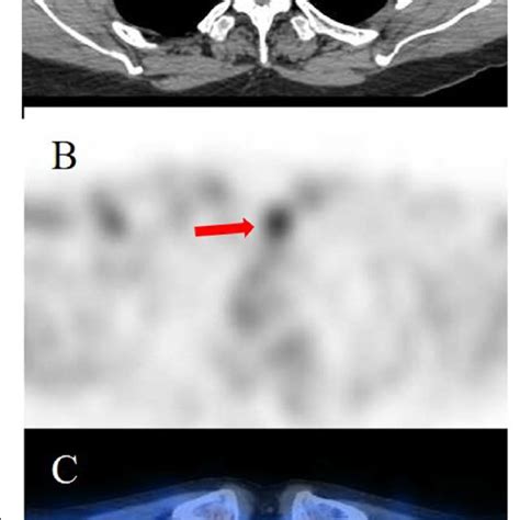 The M Tc Mibi Spect Ct Image Indicates A Low Density Lesion With High