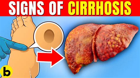 8 Warning Signs Of Cirrhosis You Need To Know Youtube