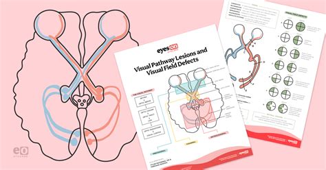 Visual Pathway Lesions And Corresponding Visual Field Defects With Download