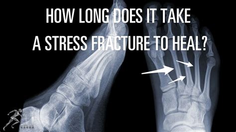 How Long Does It Take A Stress Fracture To Heal Youtube