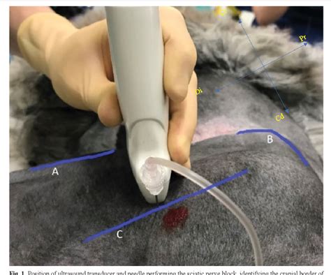 Figure 1 From Ultrasound Guided Psoas Compartment And Sciatic Nerve