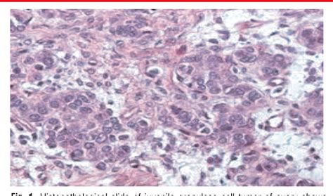 Figure 1 from Juvenile granulosa cell ovarian tumor- a rare presentation | Semantic Scholar