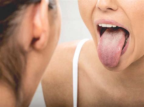 Pictures Of Early Signs Of Tongue Cancer Infoupdate Org