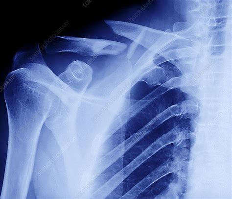 Fractured collar bone, X-ray - Stock Image - M330/1356 - Science Photo Library