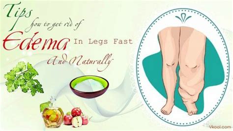 19 Tips How To Get Rid Of Edema In Legs Fast And Naturally