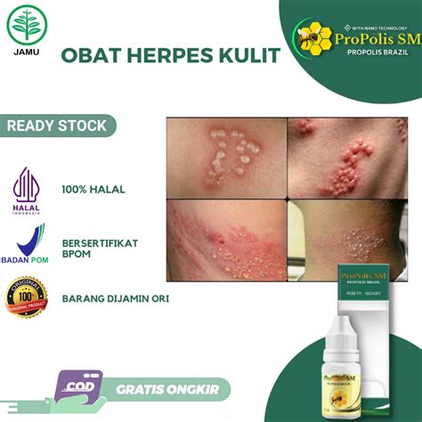 Jual Obat Herpes Kulit Anak Dewasa Herpes Simplex Herpes Zoster Herpes