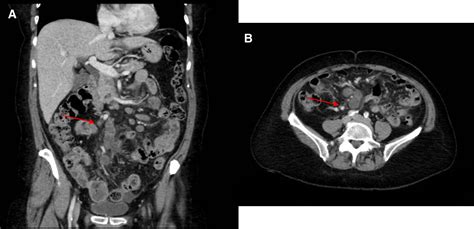 Duodenal Metastasis In Triple Negative Invasive Ductal Breast Carcinoma