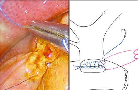 A Posterior Wall Suture Of Choledochojejunostomy B Sch Ematic