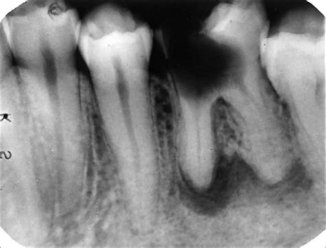 Fouady Endodoncia Clasificaci N De Enfermedades Pulpares Y