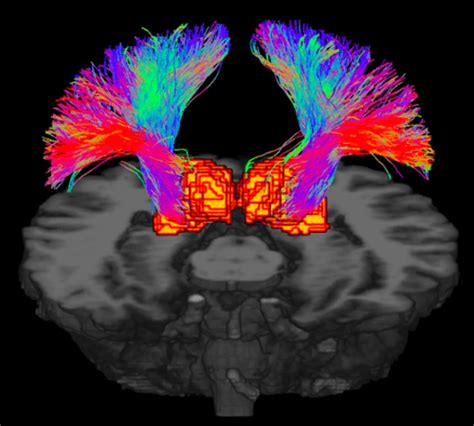 First Application Of 7 T Ultrahigh Field Diffusion Tensor Imaging To