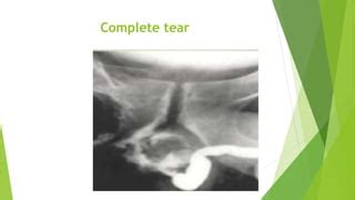 URETHRAL INJURY AND URETHRAL CARUNCLE.pptx