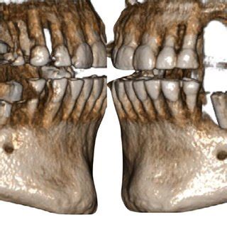 3D Reconstruction Of The Severe Maxillary And Mandibular Defects