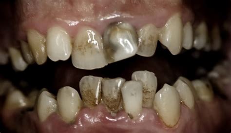 Rotten Teeth Pictures and Treatments | New Health Advisor