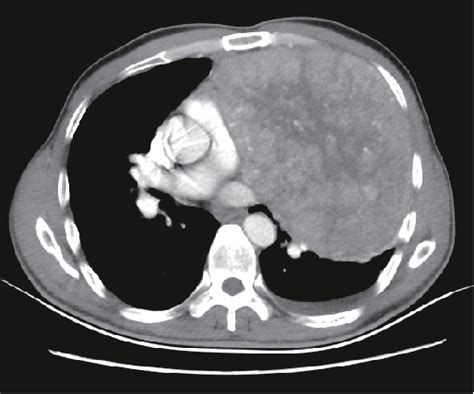 Figure 2 From Giant Thymoma Successfully Resected Via Hemiclamshell