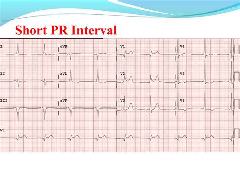 Basics Of Electrocardiographyecg Ppt