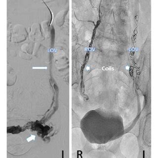 Left Ovarian Venogram Demonstrating Left Ovarian Vein Lov Dilatation