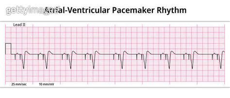 Ecg Atrial Ventricular Pacemaker Rhythm Dual Chamber 8 Second Ecg