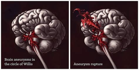 An Introduction To Brain Aneurysms — Artibiotics