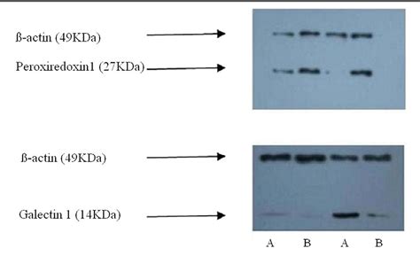 Figure 1 From Proteomic Identification Of Neoadjuvant Chemotherapy