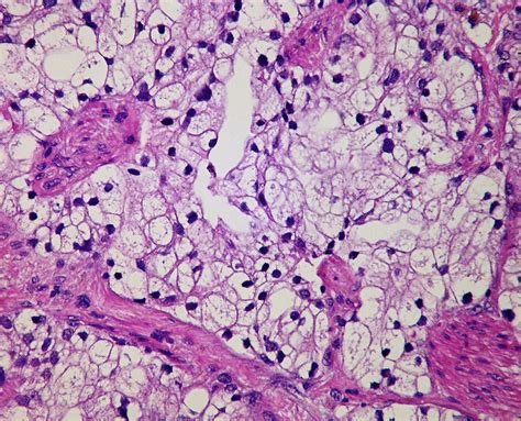 Adenocarcinoma With Clear Cells Flickr Photo Sharing