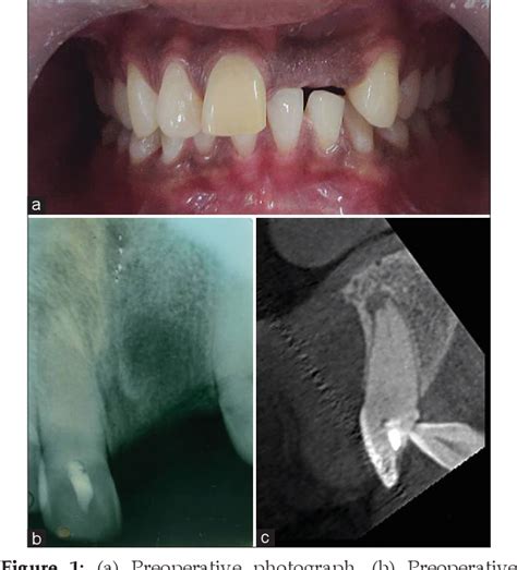 Figure From Guided Endodontic Therapy Management Of Pulp Canal