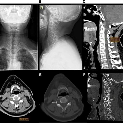 MRI of the cervical spine in a 60-yr-old female. Views: (A) The tumor ...