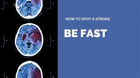 Stroke Awareness Signs And Types Of Strokes Sunways Senior Living