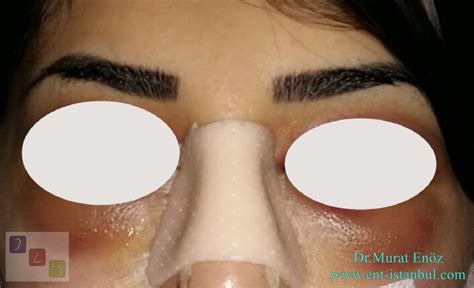 Health Zone Turkey How To Reduce Bruising And Swelling After Nose Job