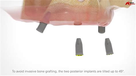 Implant Dentar Nobel Biocare Proteza Fixa Cu Implanturi Etape Si