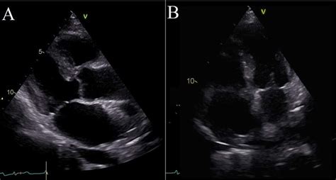 A B Transthoracic Echocardiographic 2d Images Parasternal Long Axis