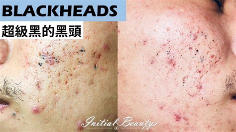 RELAX with these Deep Blackhead Extraction videos