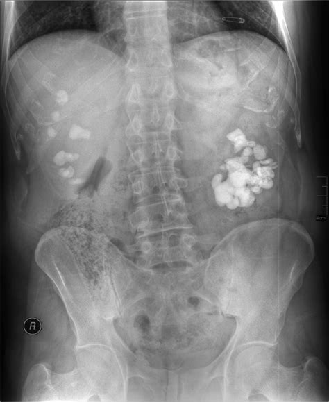 Abdominal X-ray Interpretation (AXR) | Geeky Medics
