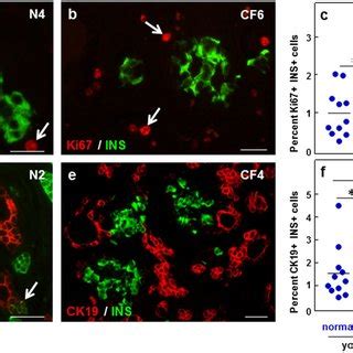 Pancreatic Beta Cell Proliferation And Neogenesis In Normal And Cf