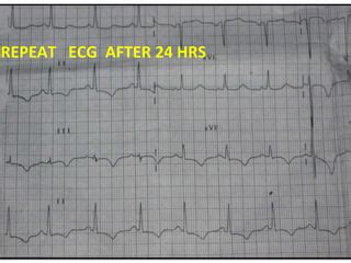 Ecg Lbbb And Acute Mi Ppt